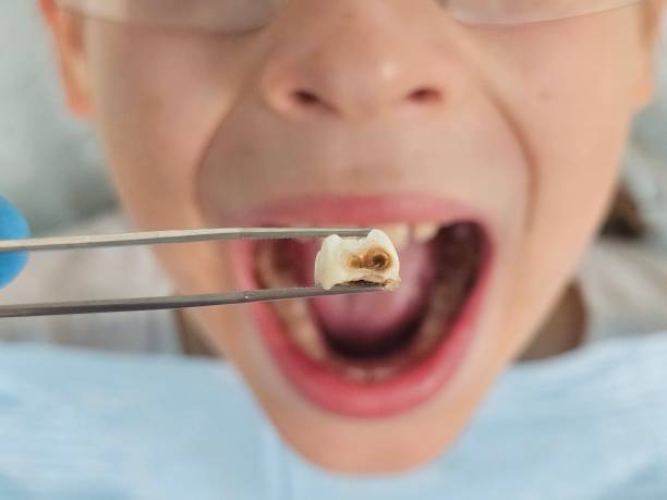 Best Emergency Tooth Extraction in Edneyville, NC